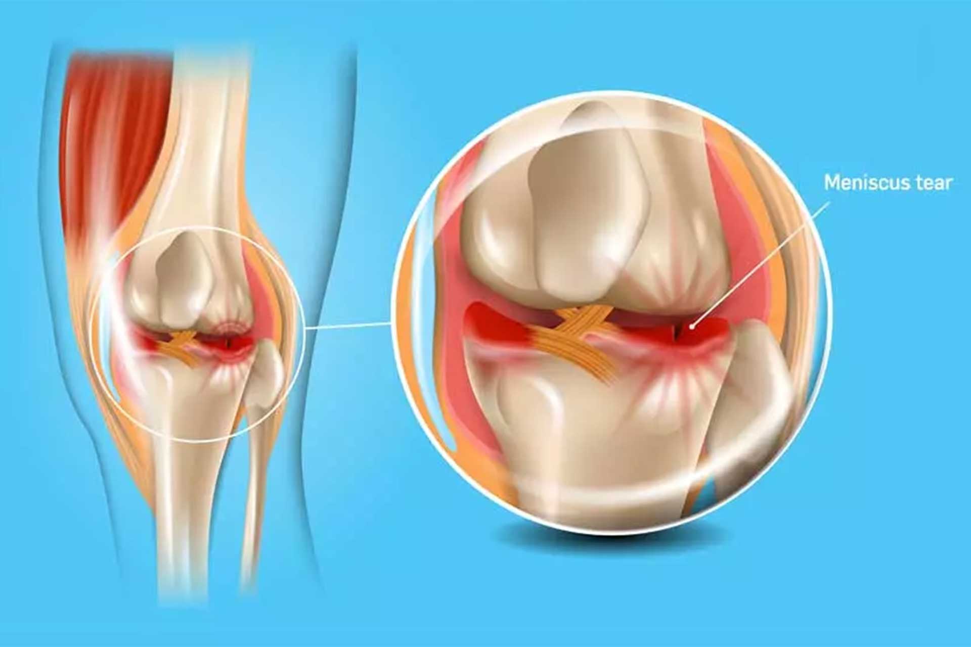 Воспаление коленных связок лечение