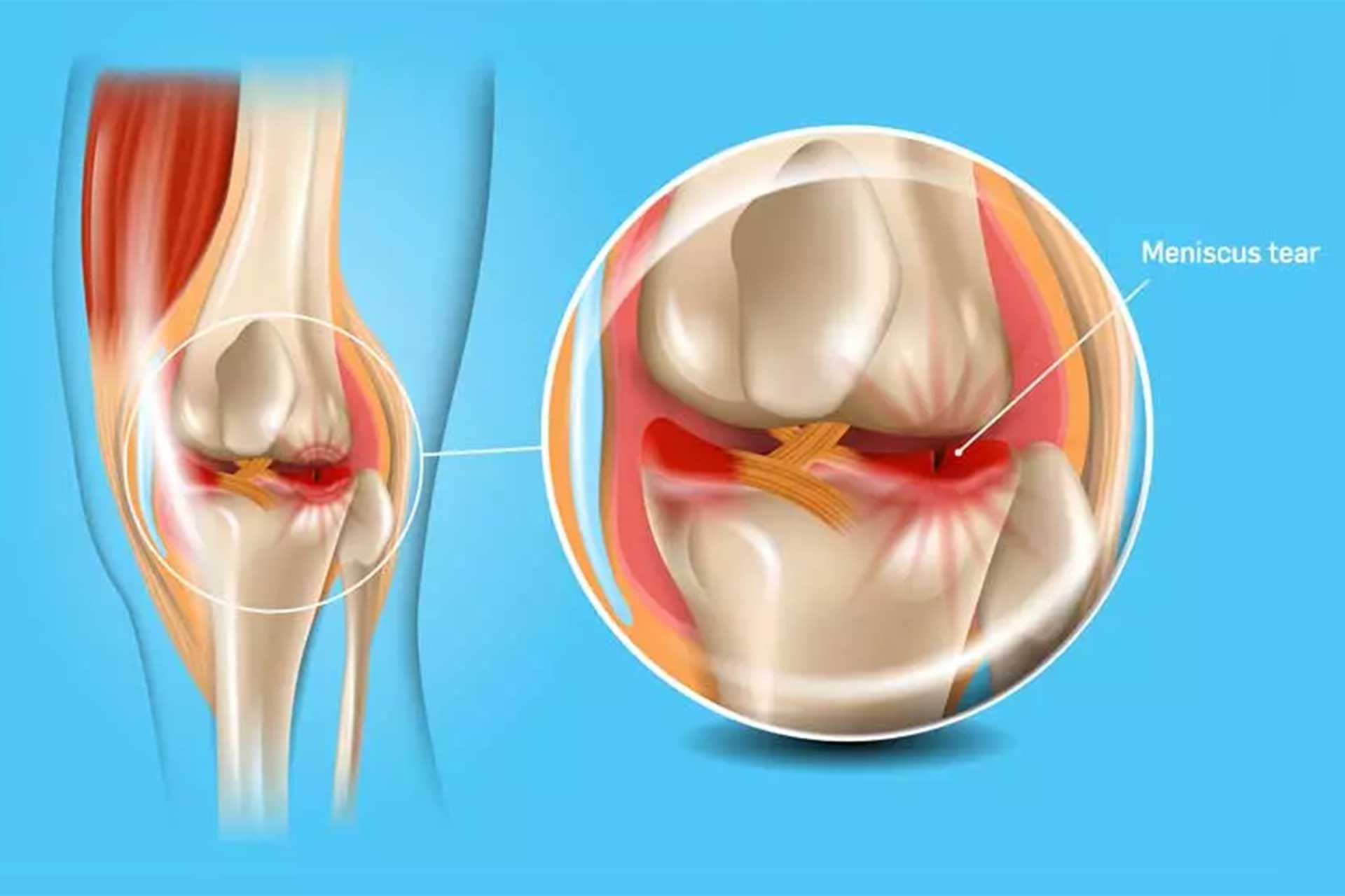 Поврежденный мениск коленного сустава