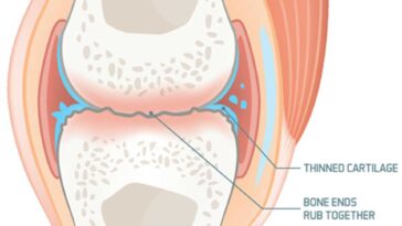 How Gallic Acid And Stretching Combo Can Help Improve Osteoarthritis