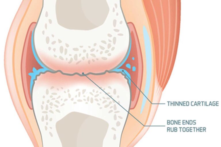 How Gallic Acid And Stretching Combo Can Help Improve Osteoarthritis