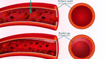 How To Reduce Blood Pressure Safely And Effectively Without Meds F