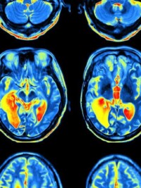 What Sleep Deprivation Does to the Brain, Step by Step