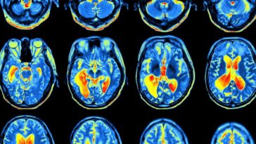 brain scans
